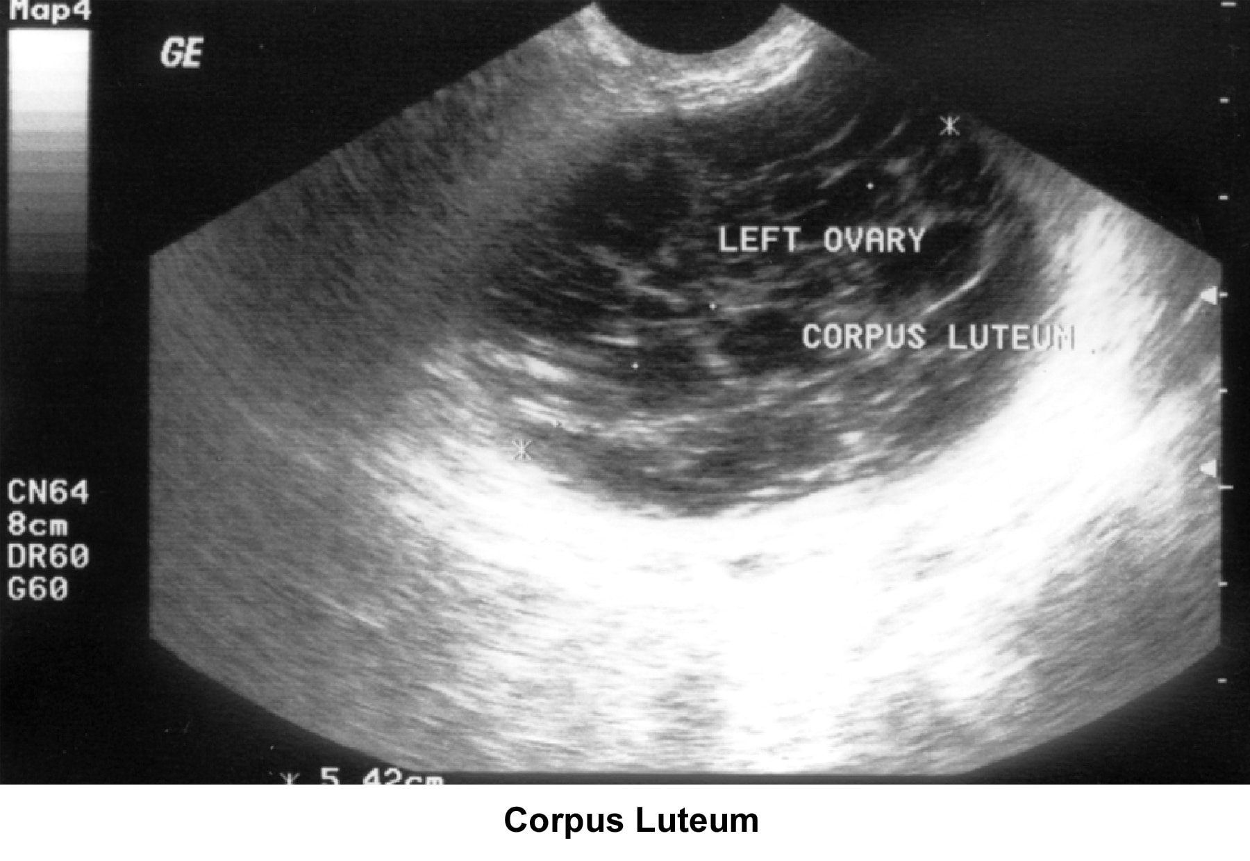 Infertility. Corpus luteum. Image courtesy of Jai...