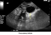 Infertility. Preovulatory follicle. Image courtes...