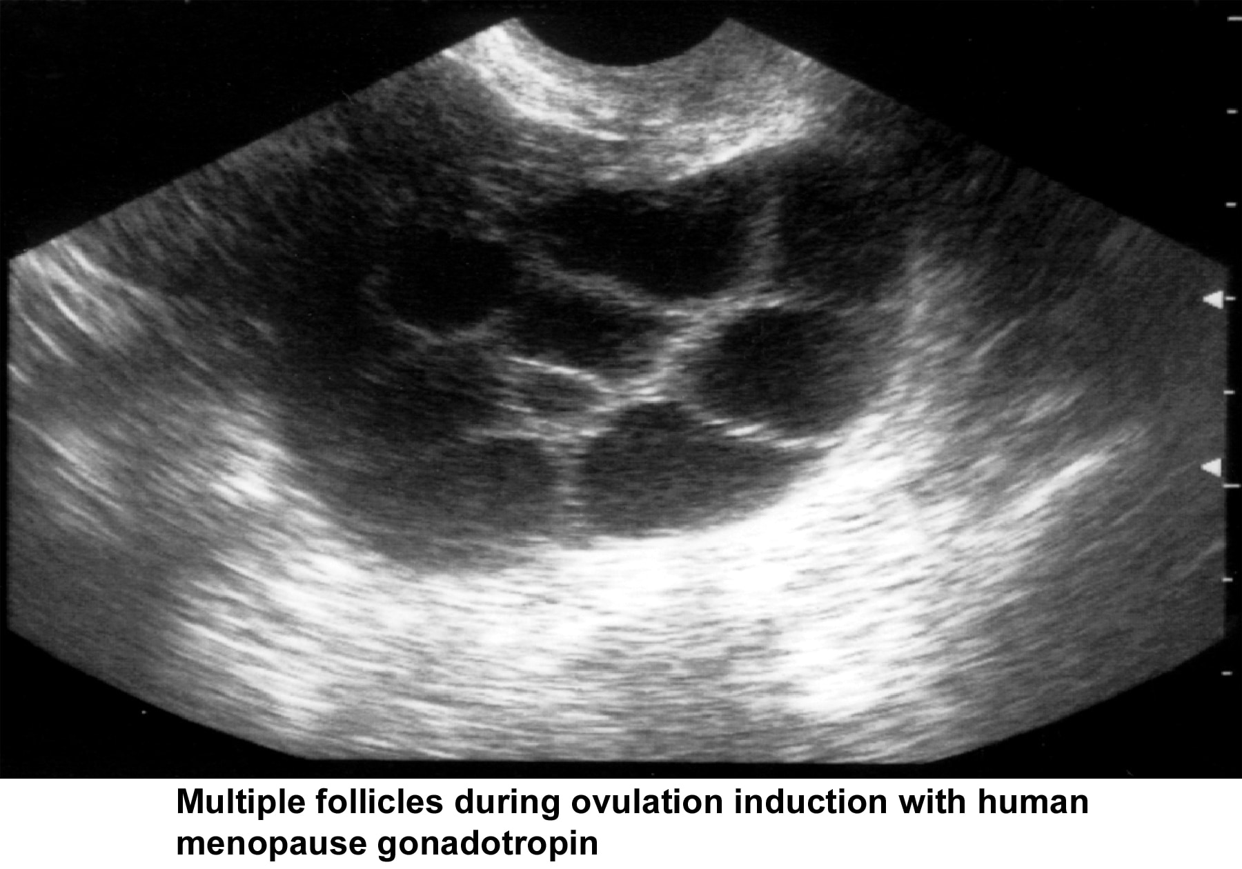Infertility. Multiple follicles during ovulation ...