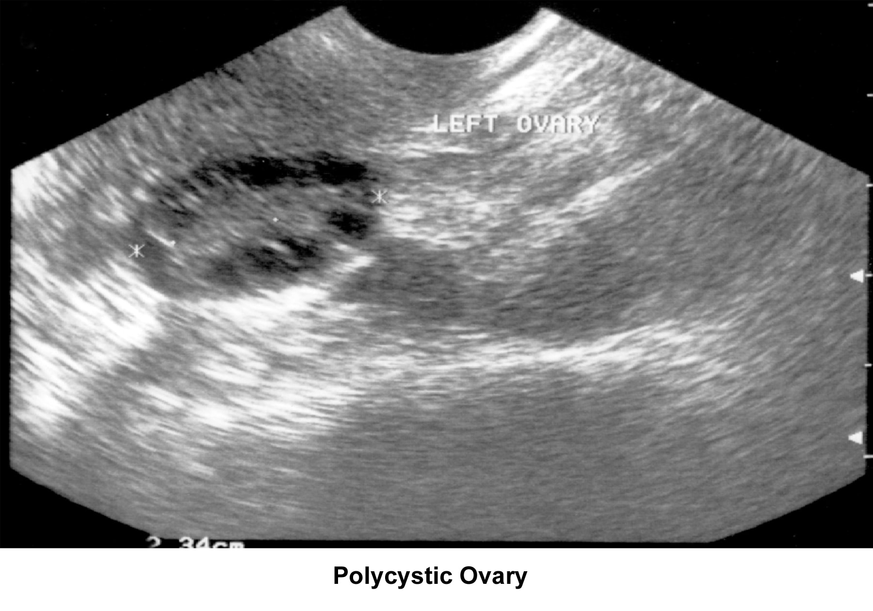 Infertility. Polycystic ovary. Image courtesy of ...