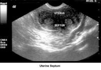 Infertility. Uterine septum. Image courtesy of Ja...