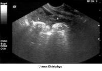 Infertility. Uterus didelphys. Image courtesy of ...
