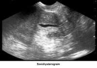 Infertility. Sonohysterogram. Image courtesy of ...