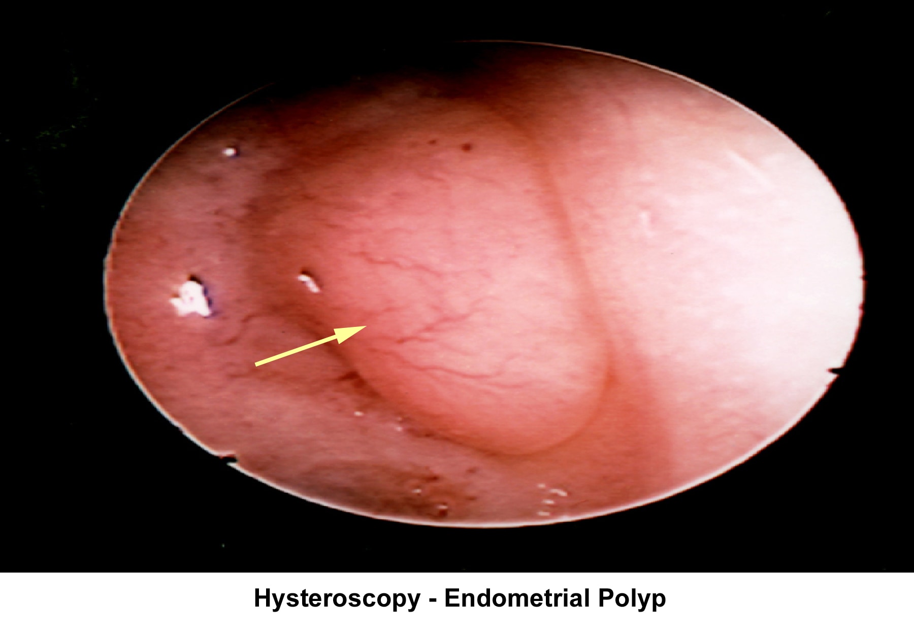 Infertility. Hysteroscopy - Endometrial polyp. I...