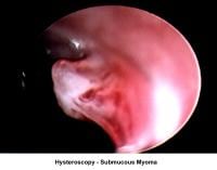 Infertility. Hysteroscopy - Submucous fibroid. I...