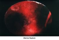 Infertility. Uterine septum. Image courtesy of J...