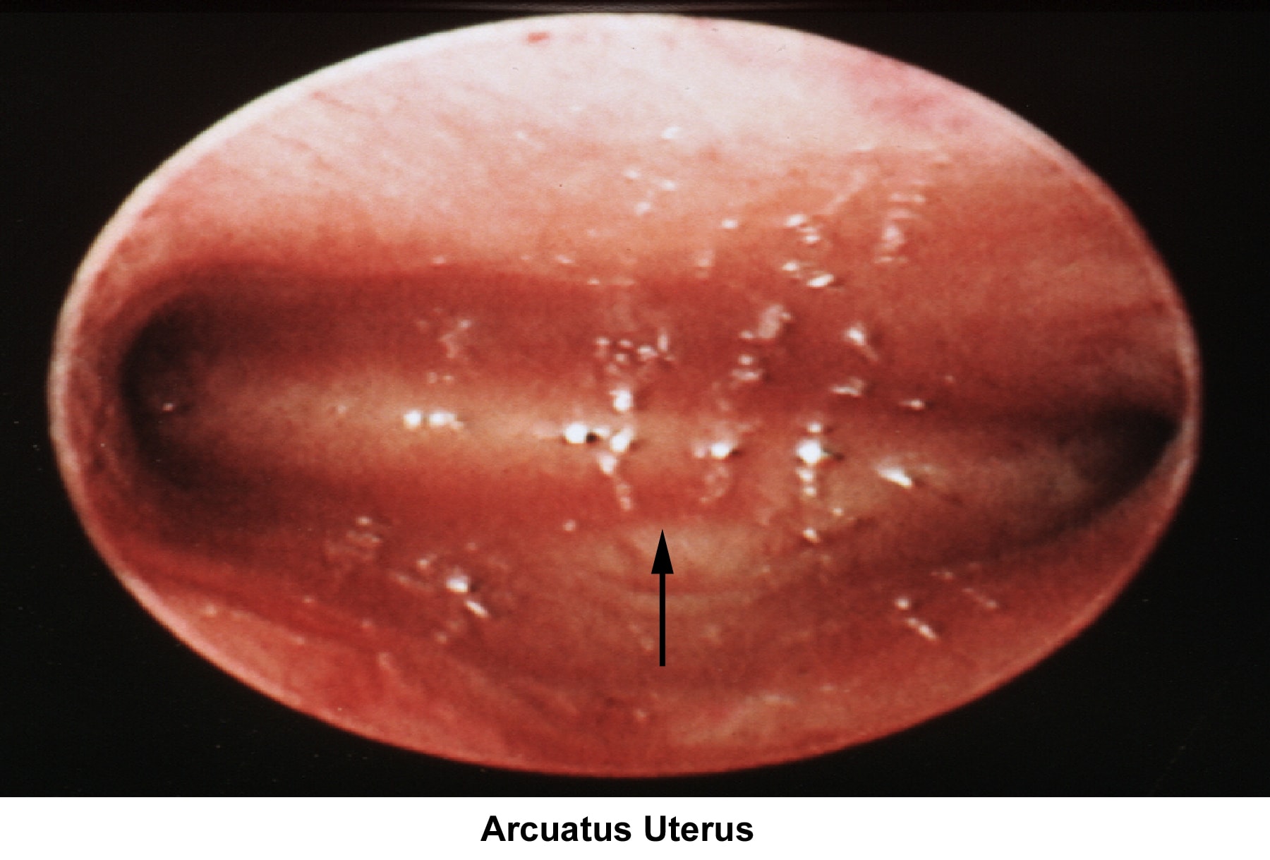 Infertility. Arcuate uterus. Image courtesy of J...