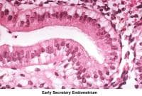 Infertility. Early secretory endometrium. Image ...