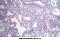 Infertility. Mid secretory endometrium. Image co...