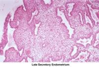 Infertility. Late secretory endometrium. Image c...