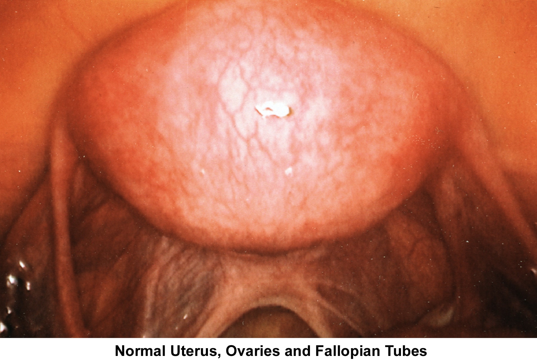 Infertility. Normal uterus, ovaries, and fallopia...