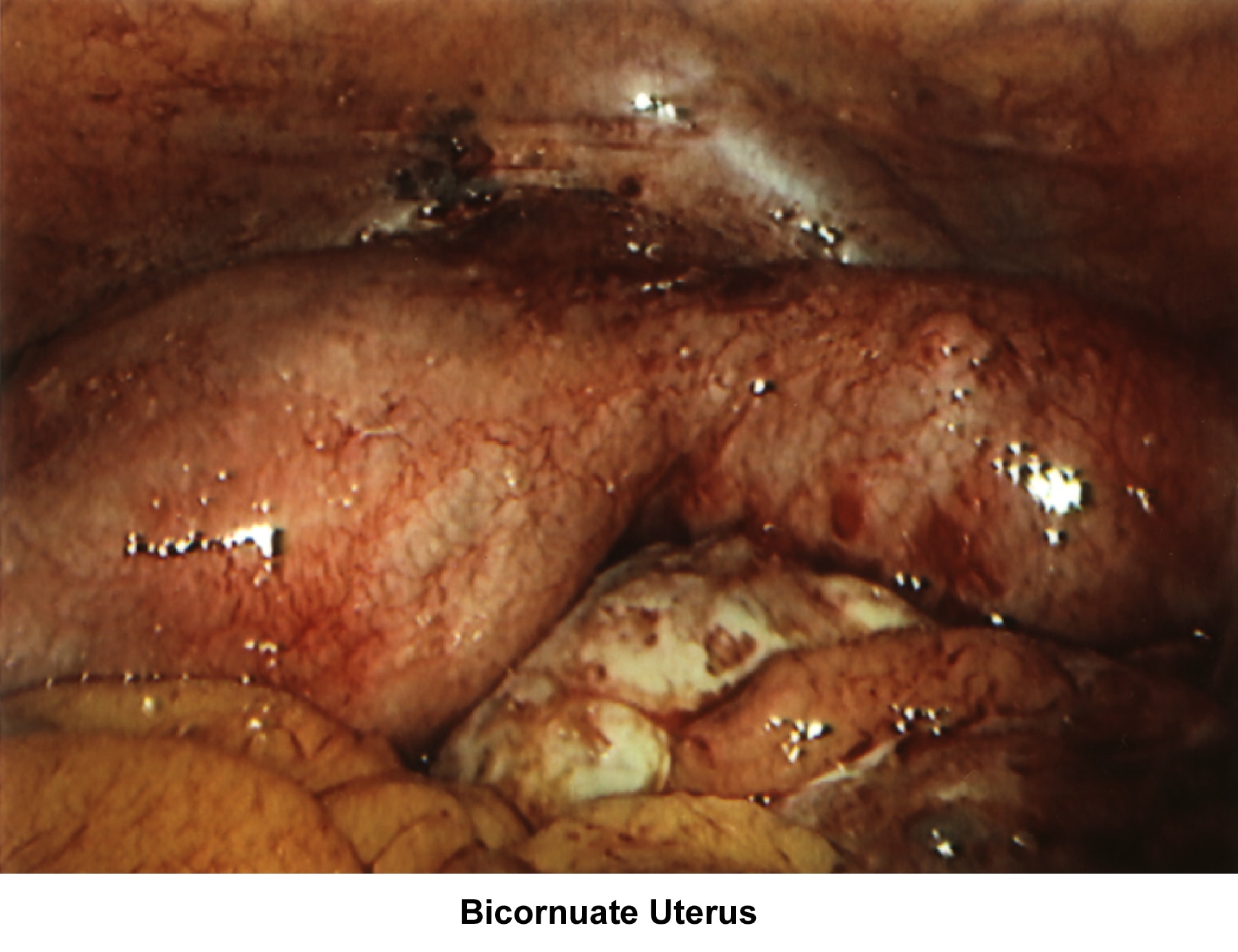 Infertility. Bicornuate uterus. Image courtesy o...