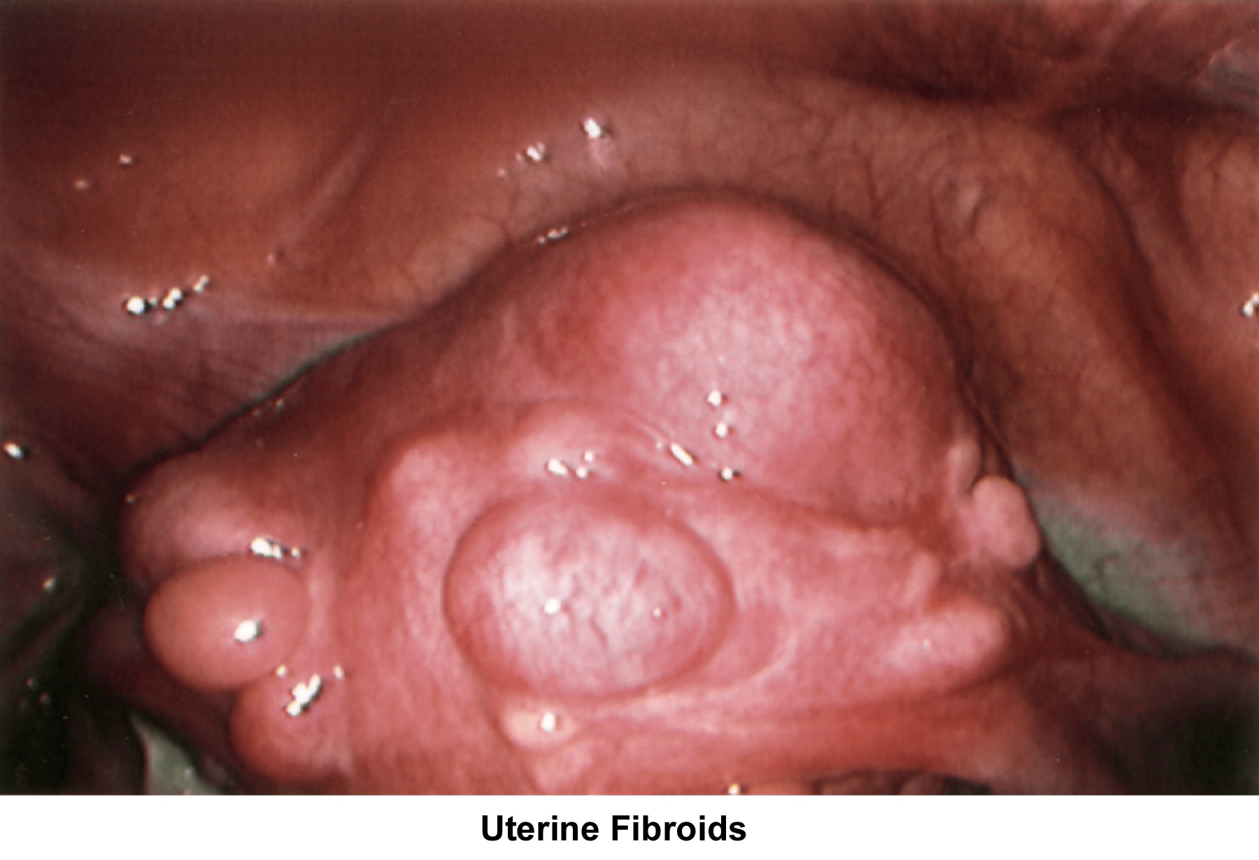 Infertility. Uterine fibroids. Image courtesy of...