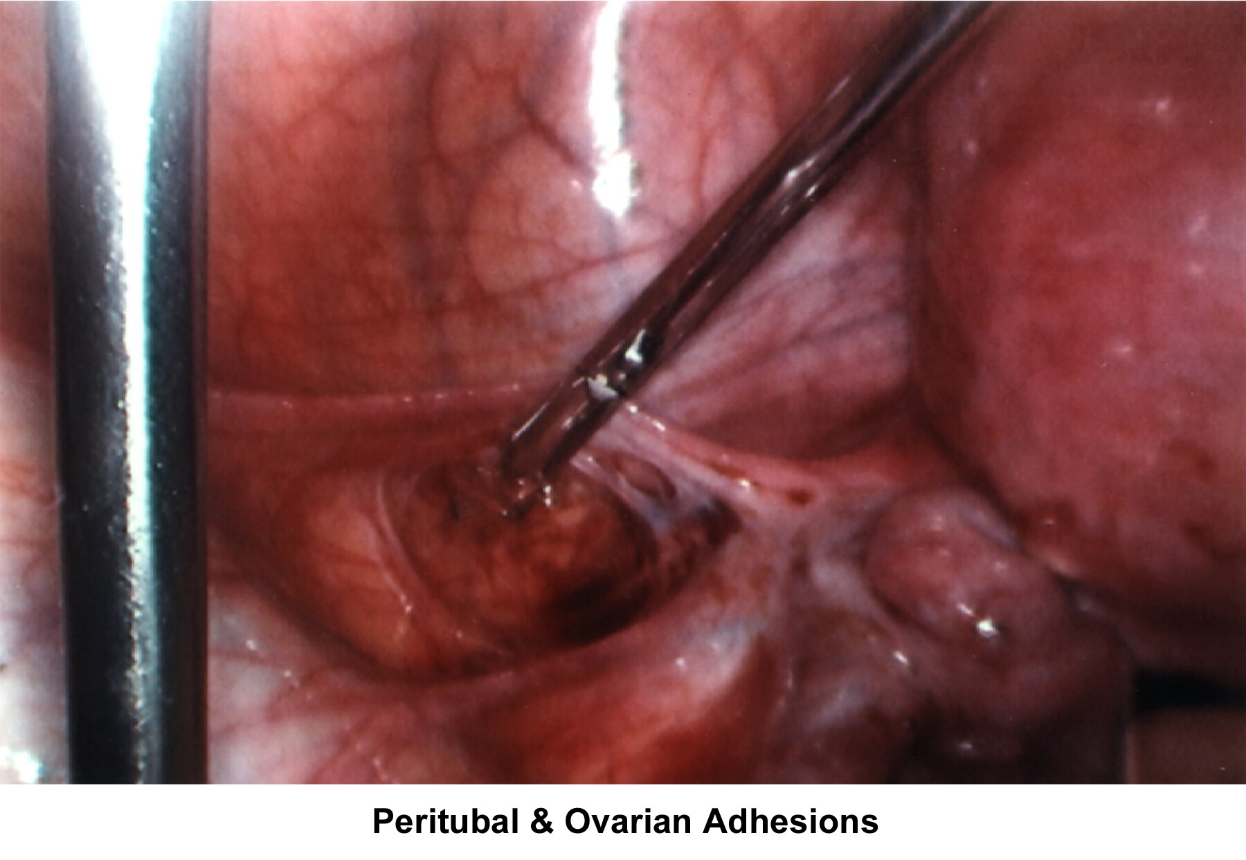 Infertility. Peritubal and ovarian adhesions. Im...