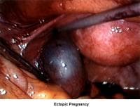 Infertility. Ectopic pregnancy. Image courtesy o...