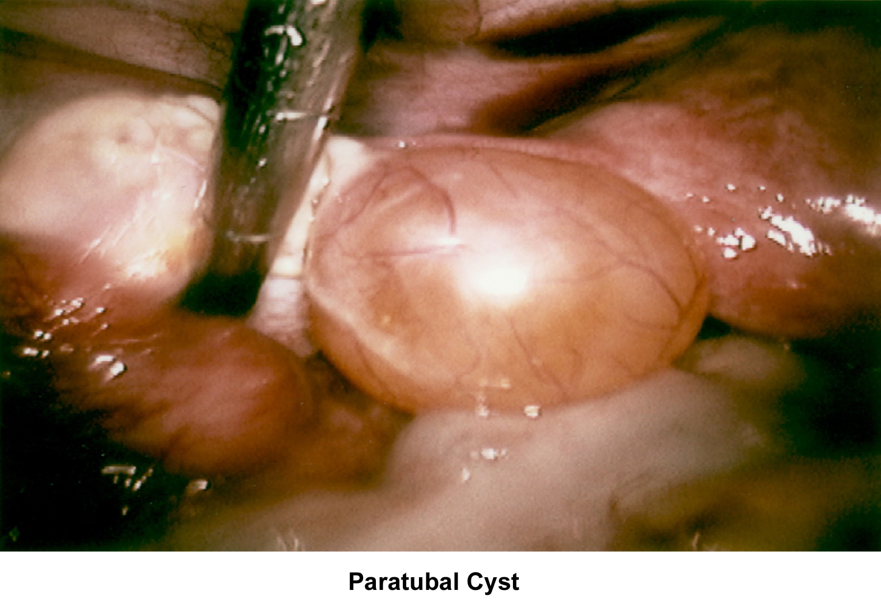 Infertility. Paratubal cyst. Image courtesy of J...