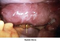 Infertility. Septate uterus. Image courtesy of J...