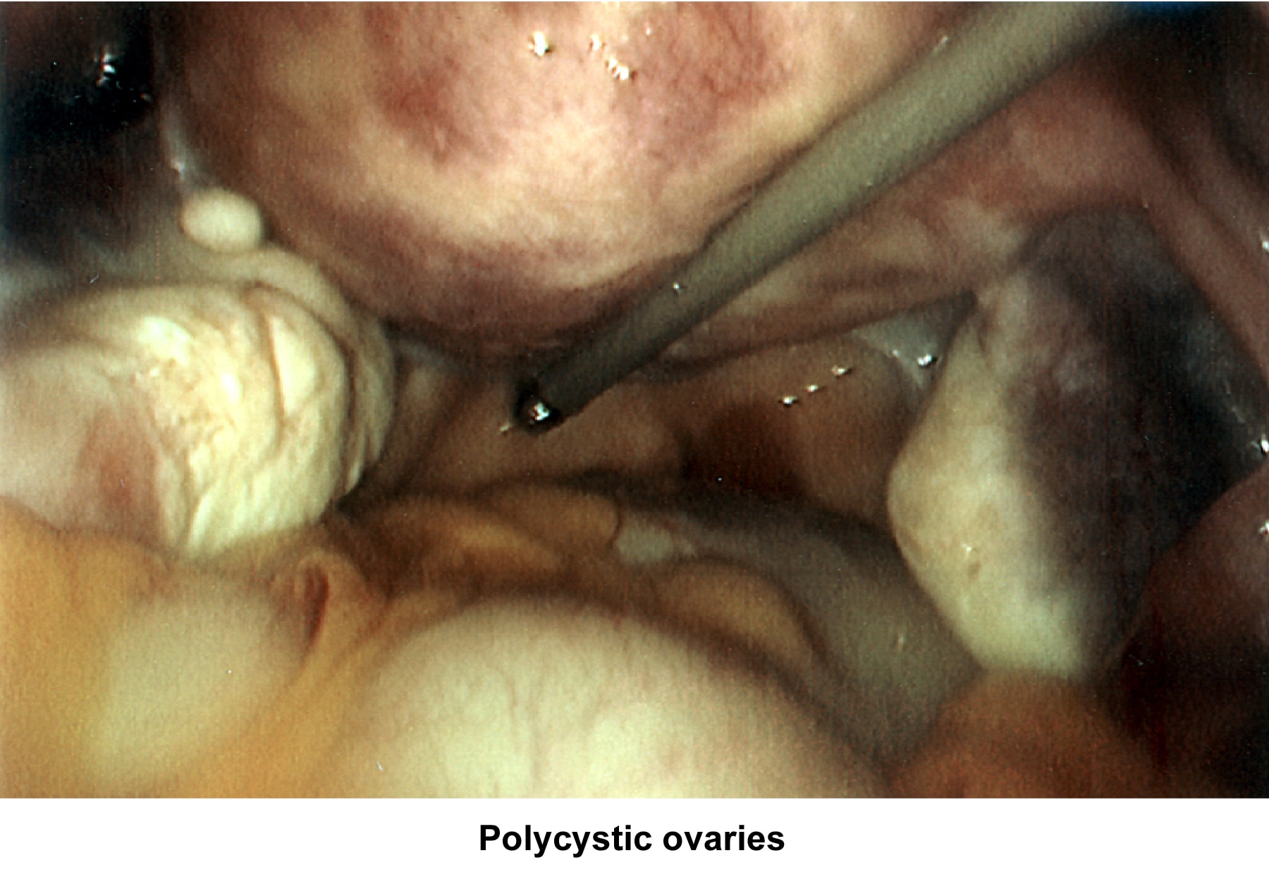 Infertility. Polycystic ovaries. Image courtesy ...