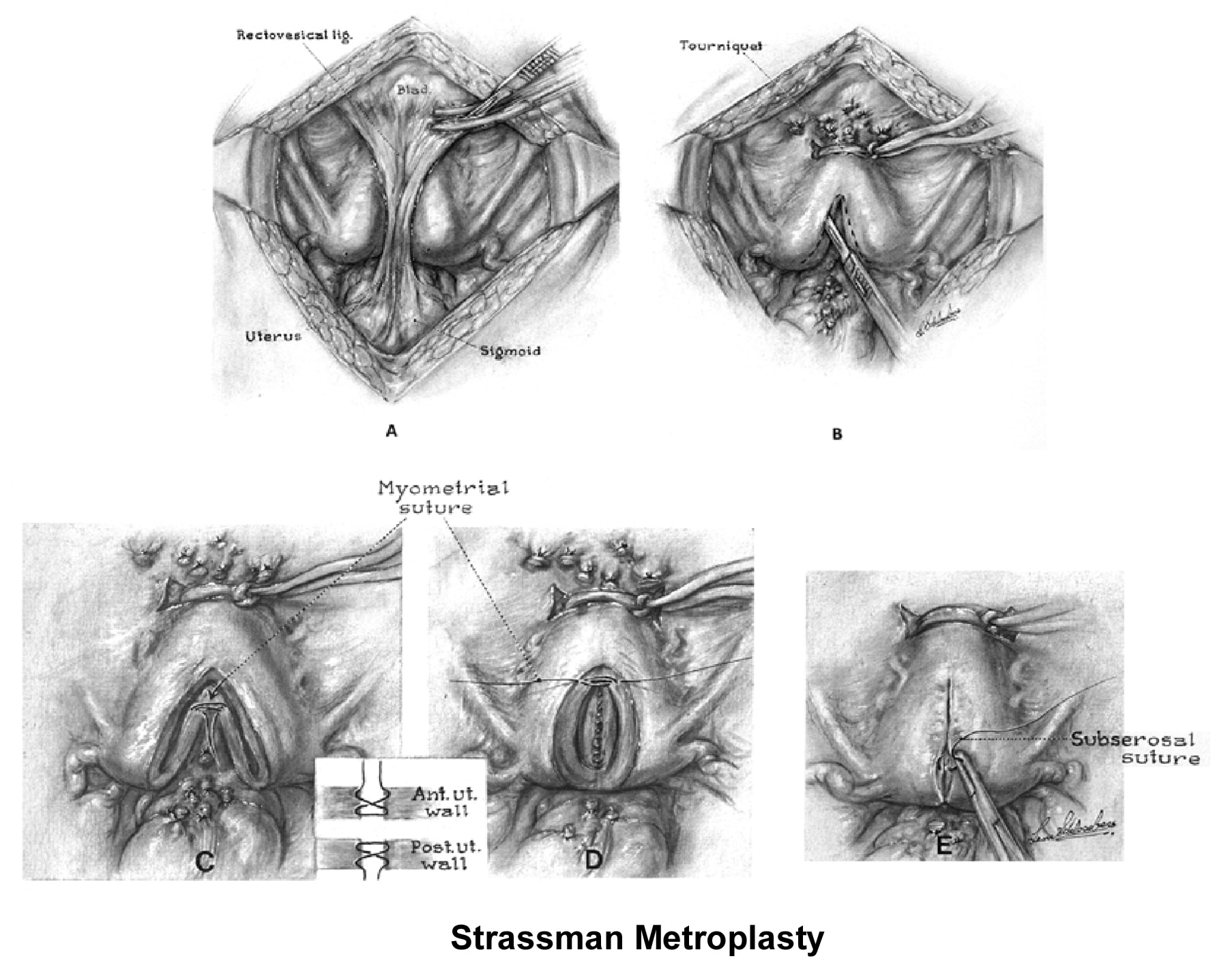 Infertility. Metroplasty - Strassman technique. ...