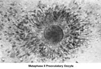 Infertility. Metaphase II preovulatory oocyte. I...