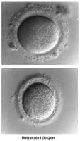 Infertility. Metaphase I oocytes. Image courtesy...