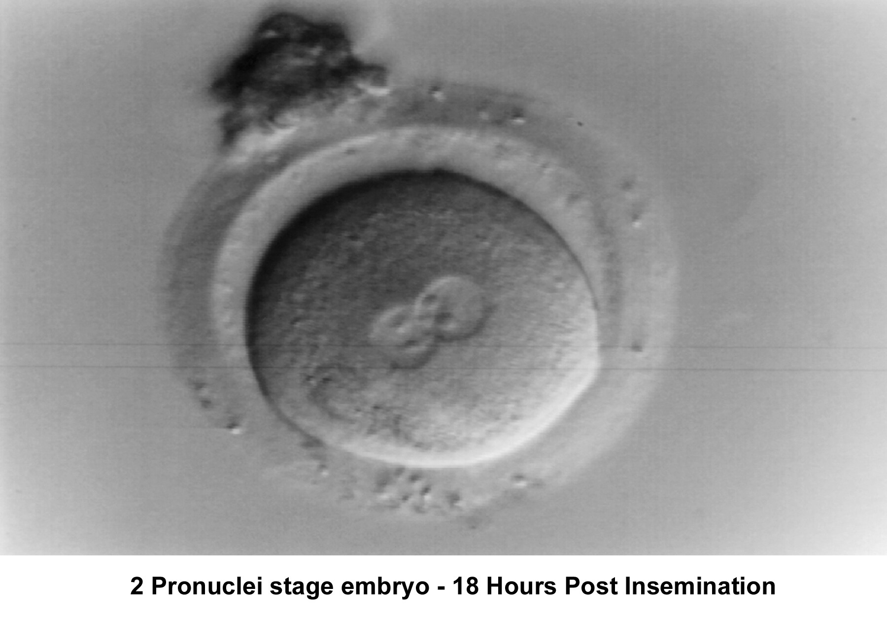 Infertility. Two-pronuclei stage embryo - Eightee...