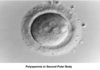 Infertility. Polyspermia or second polar body. I...