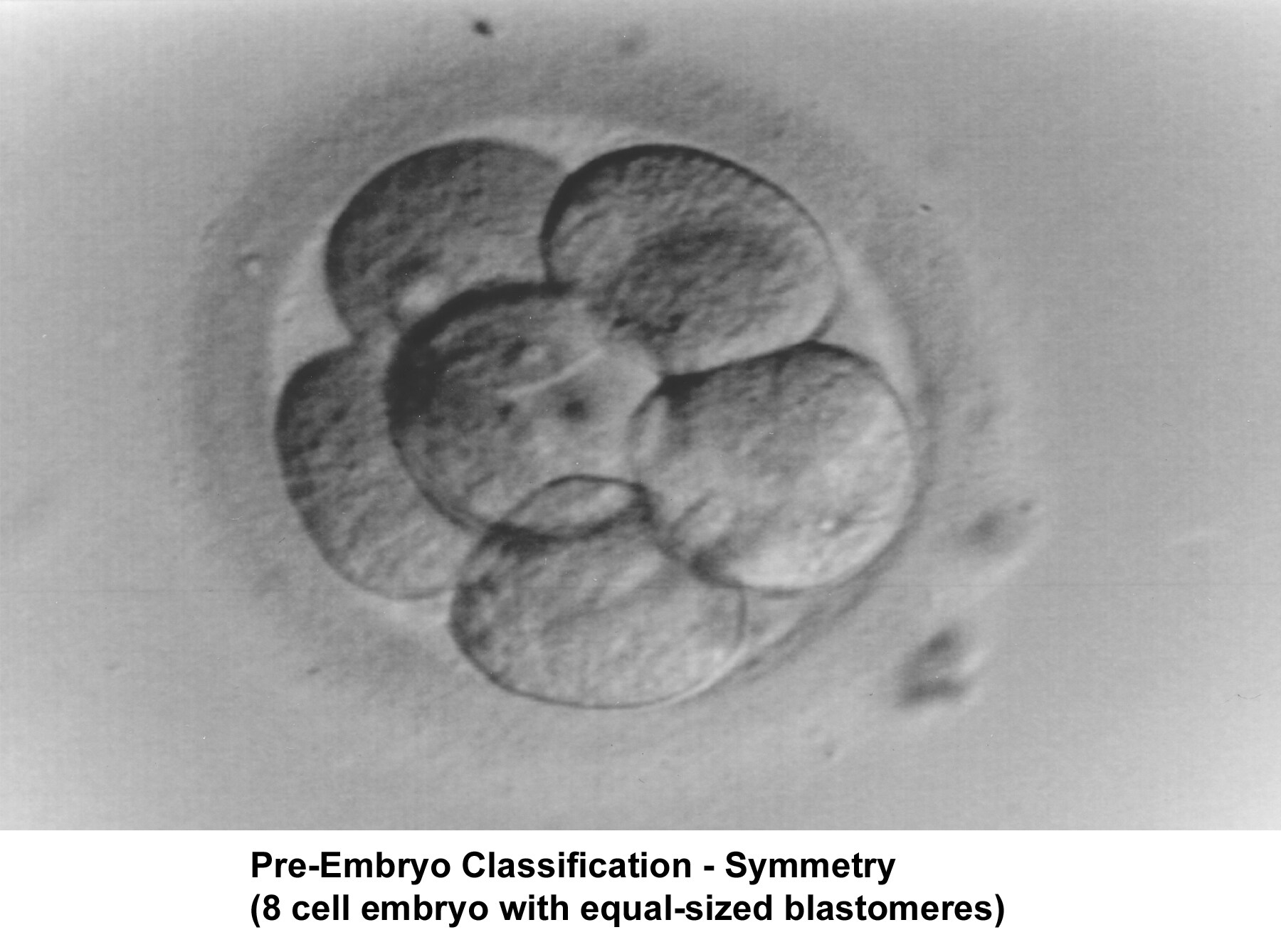 Infertility. Preembryo classification - Symmetry ...