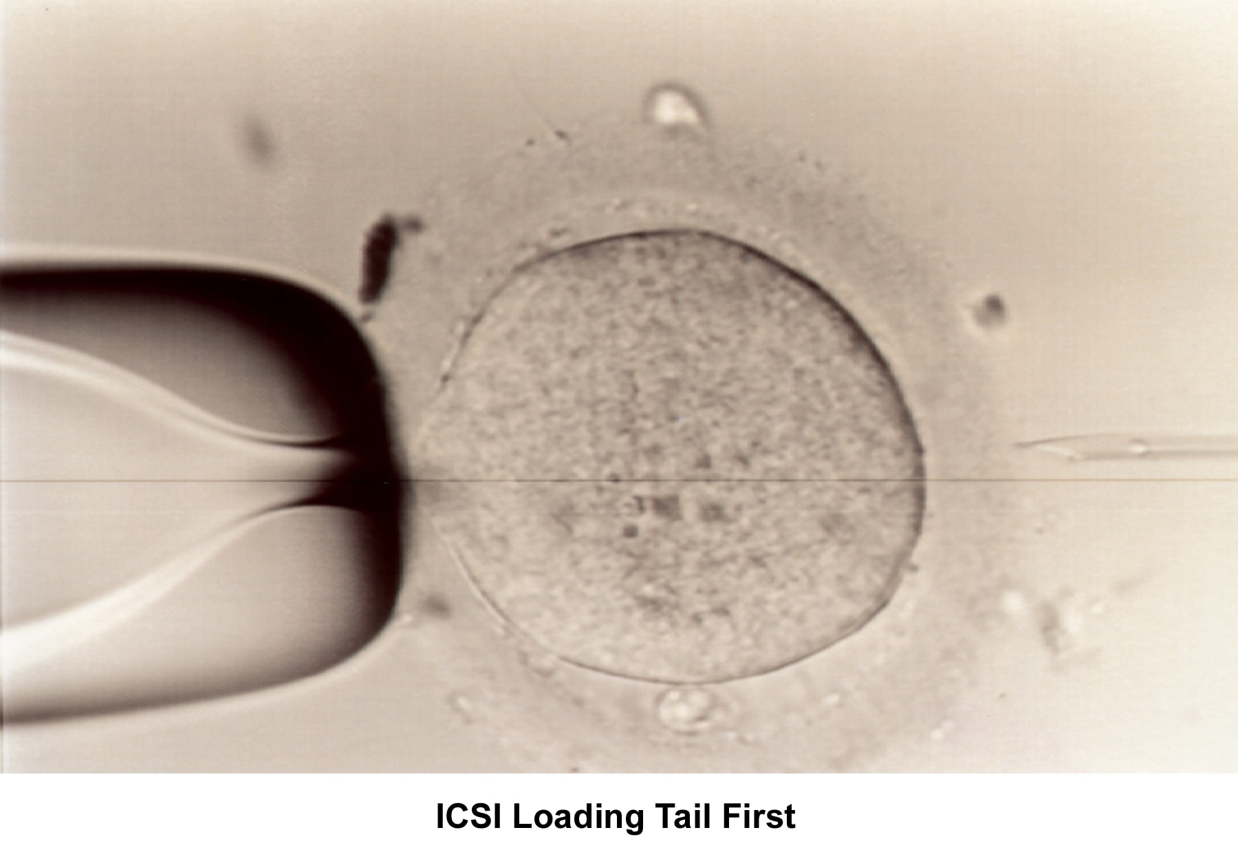 Infertility. Intracytoplasmic sperm injection loa...