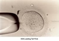 Infertility. Intracytoplasmic sperm injection loa...