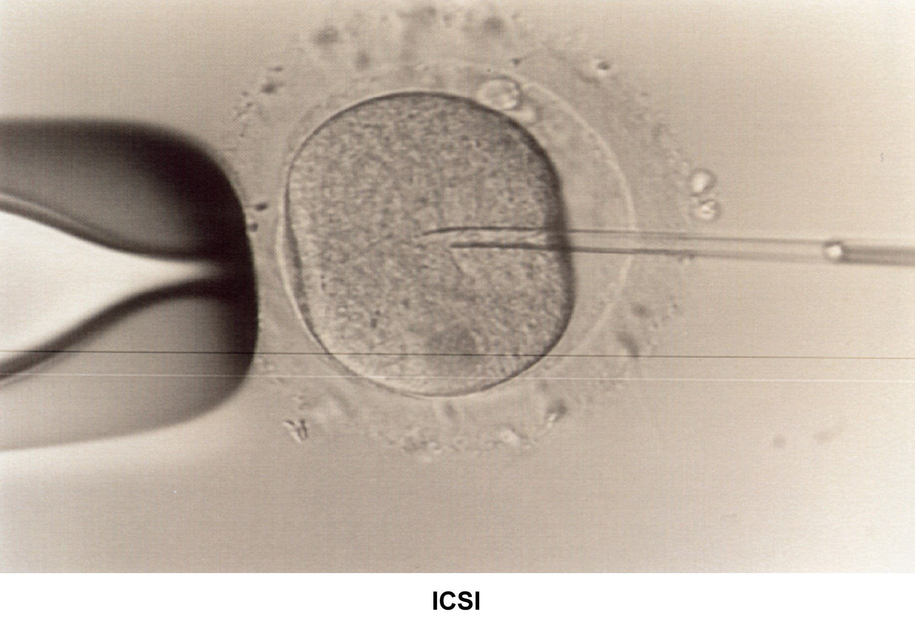 Infertility. Intracytoplasmic sperm injection. I...