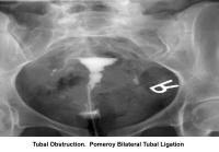 Infertility. Tubal obstruction: Pomeroy bilateral...