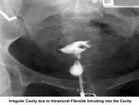 Infertility. Irregular cavity due to intramural f...