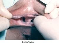 Infertility. Double vagina. Image courtesy of Jai...