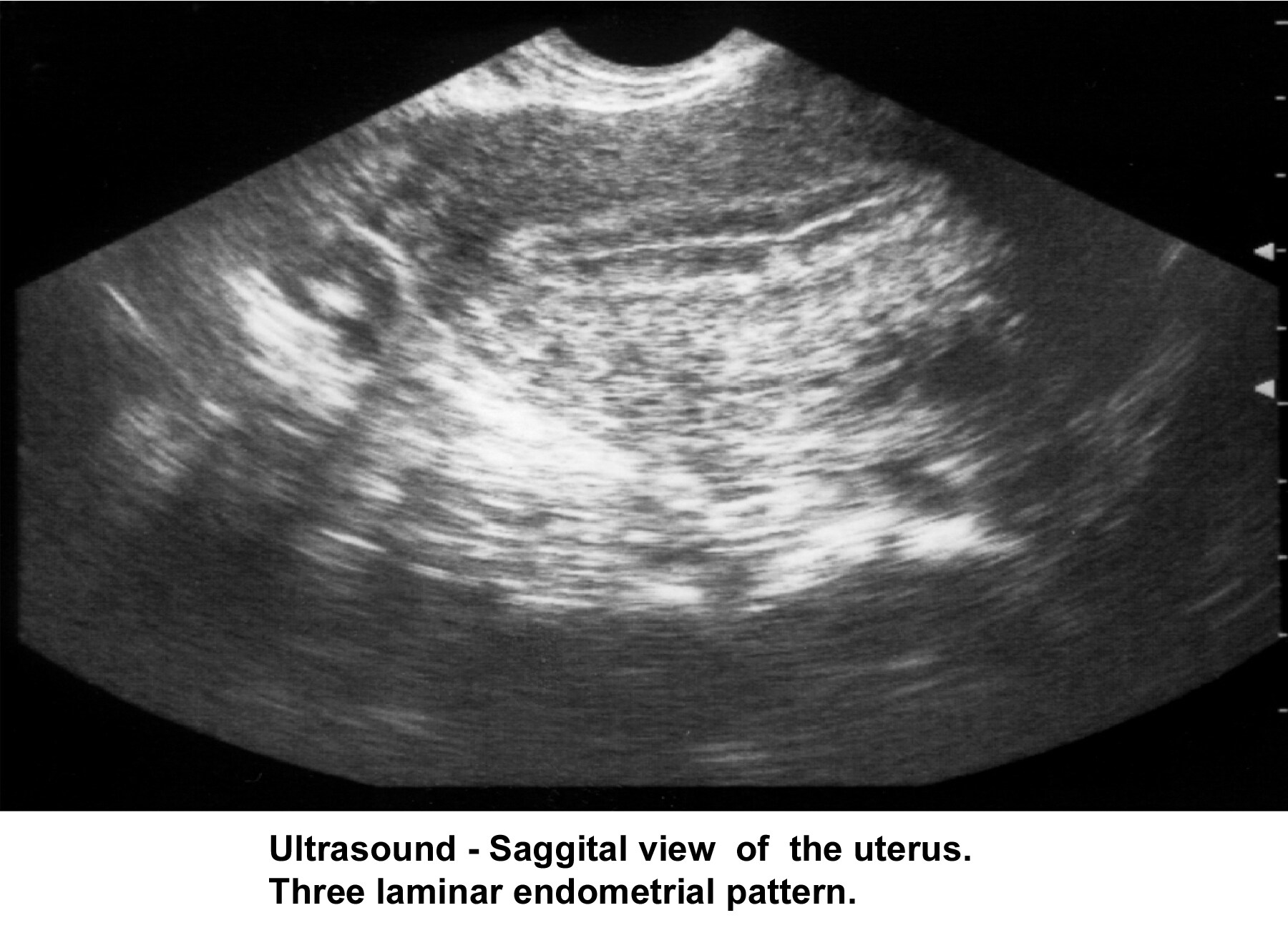 Infertility. Sonogram: Sagittal view of the uteru...