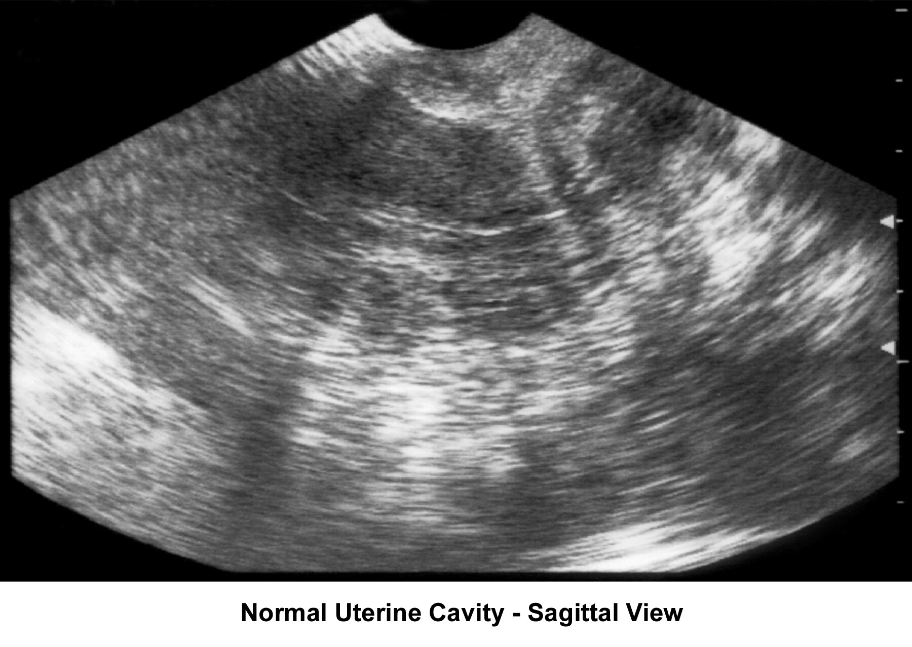 Infertility. Sonogram: Sagittal view of normal ut...
