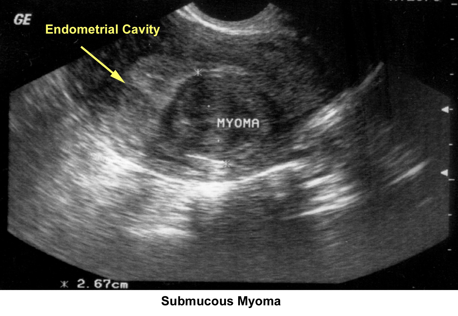 Infertility. Submucous myoma. Image courtesy of ...