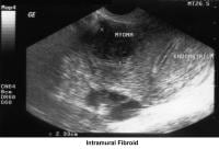Infertility. Intramural fibroid. Image courtesy ...