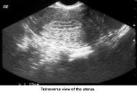 Infertility. Sonogram: Transverse view of the ute...