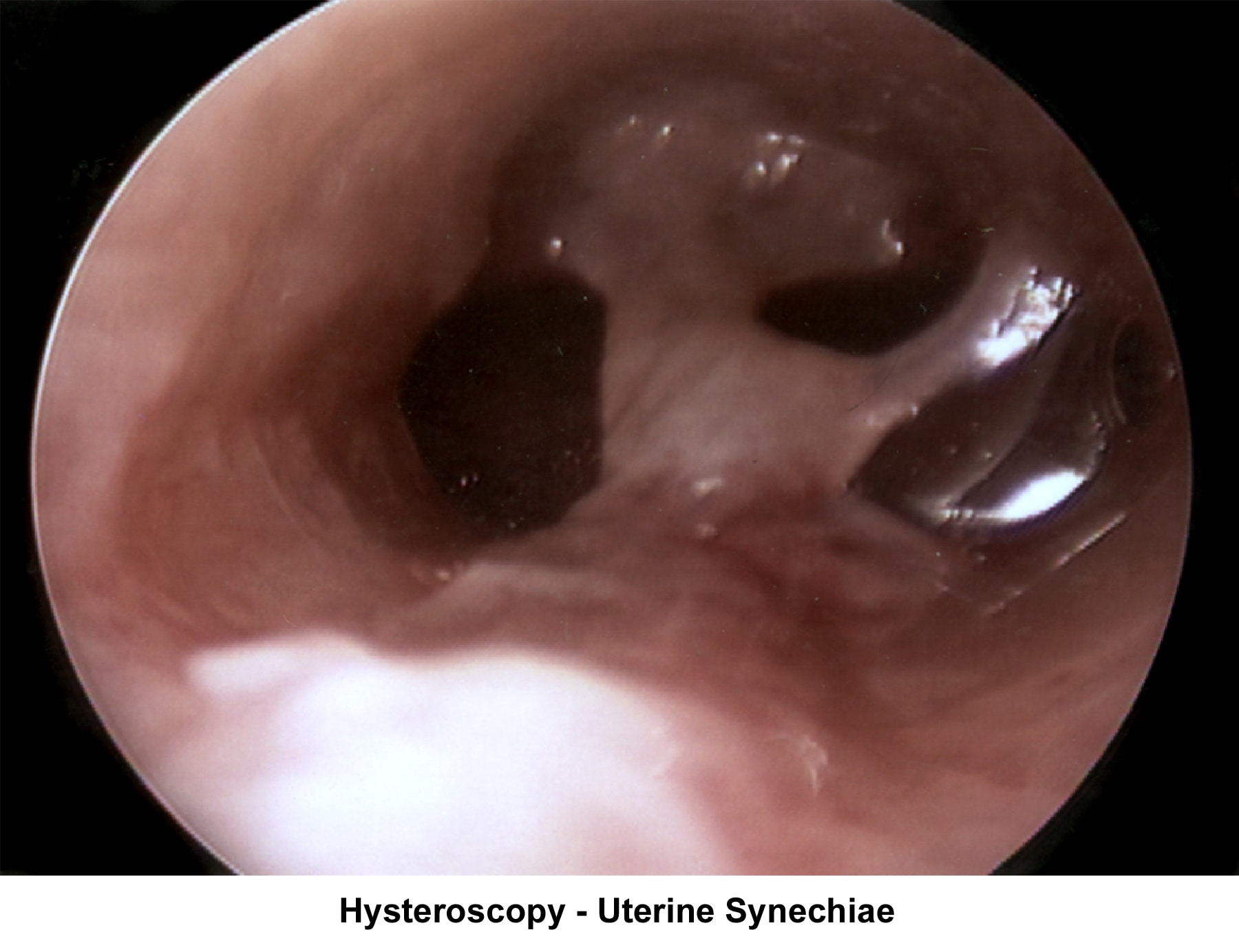 Infertility. Hysteroscopy - Uterine synechiae. I...