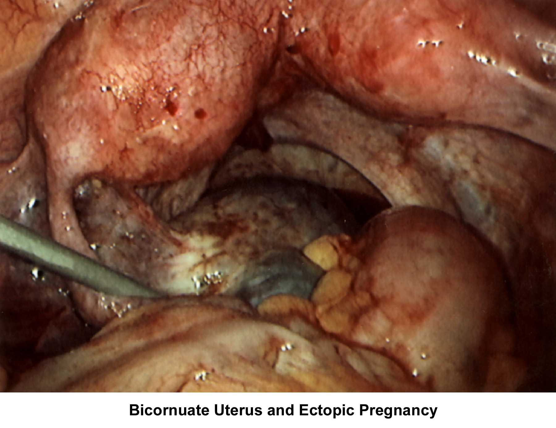 Infertility. Bicornuate uterus and ectopic pregna...