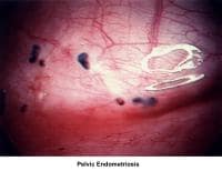 Infertility. Pelvic endometriosis. Image courtes...