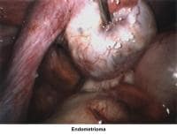 Infertility. Endometrioma. Image courtesy of Jai...