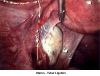 Infertility. Uterus - Tubal ligation. Image cour...