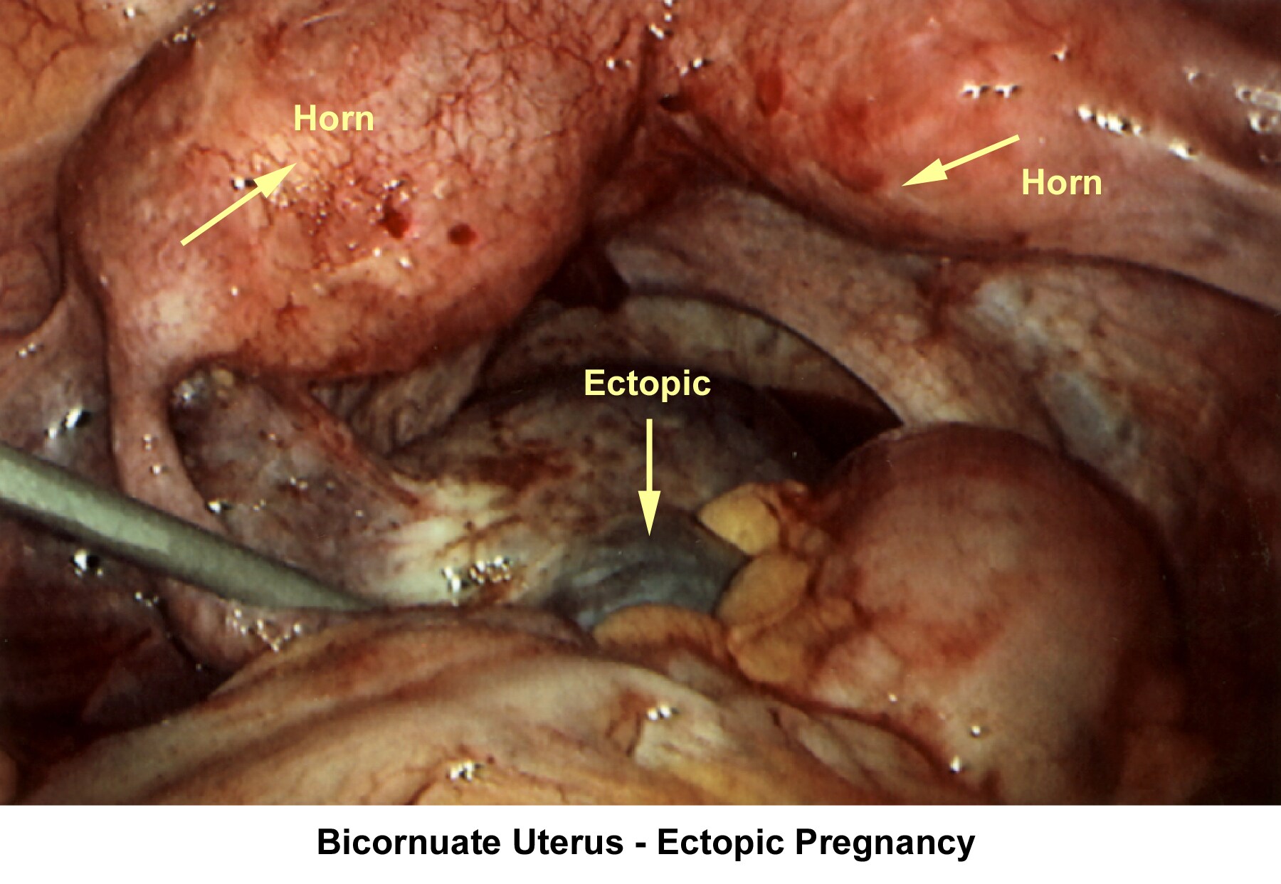 Infertility. Bicornuate uterus - Ectopic pregnanc...