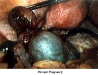 Infertility. Ectopic pregnancy. Image courtesy o...