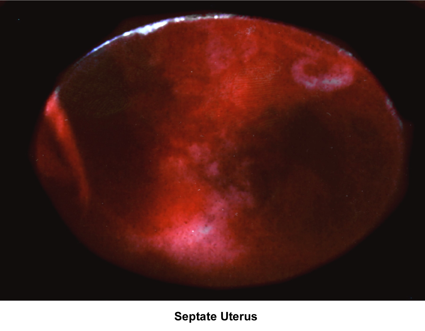 Infertility. Septate uterus. Image courtesy of J...