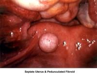 Infertility. Septate uterus and pedunculated fibr...