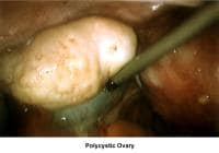 Infertility. Polycystic ovary. Image courtesy of...
