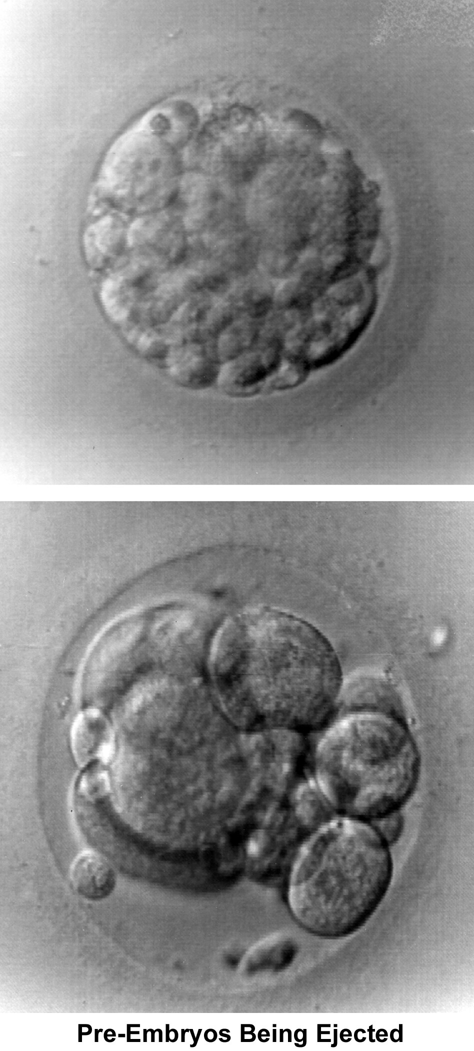 Infertility. Preembryos being ejected. Image cou...